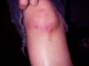 knee-day1.jpg