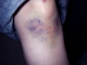 knee-day4.jpg