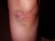 knee-day5.jpg