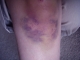 knee-day7.jpg