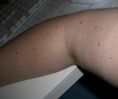 my arm.