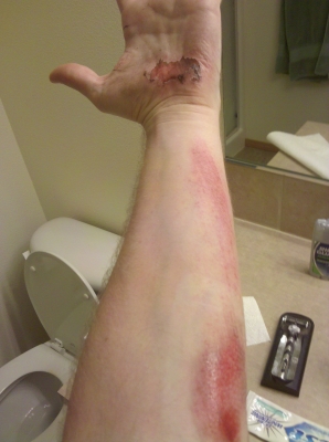 Relatively fresh image of hand and arm for story #2