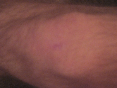 Kneecap injury from story #1