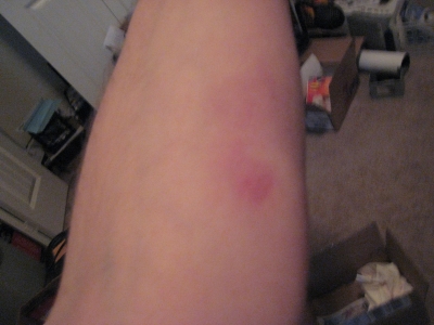 Arm injury from story #2