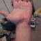 Hand injury from story #2
