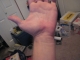 Hand injury from story #2