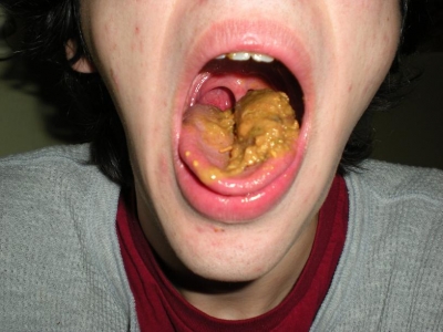 Tonsilitis