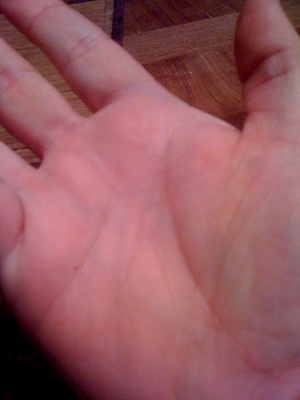 Surgery Scar Callous on Ball of Thumb