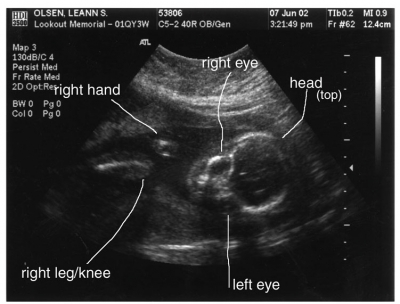 First: meet Eleanor (now 4)