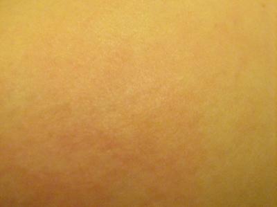 Bruise