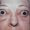 exophthalmos-eye protrusion-live photo.jpg