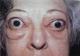 exophthalmos-eye protrusion-live photo.jpg