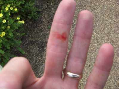 Charlie Fish's Injuries 2 Charlie Fish's Injuries 2