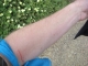 Charlie Fish's Injuries 1