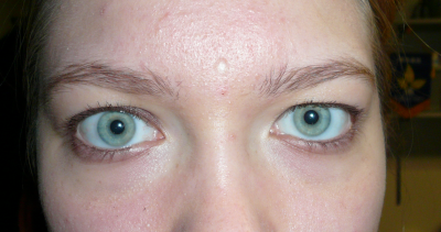 Self-Inflicted Beauty Mark