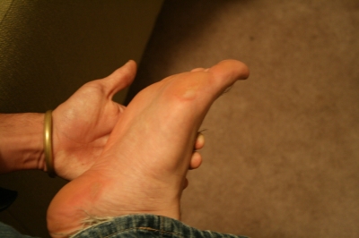 بن يامين's huge-ass blisters