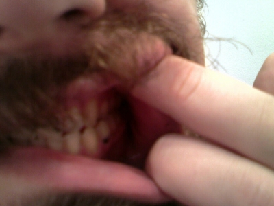 Oh hell, tooth decay