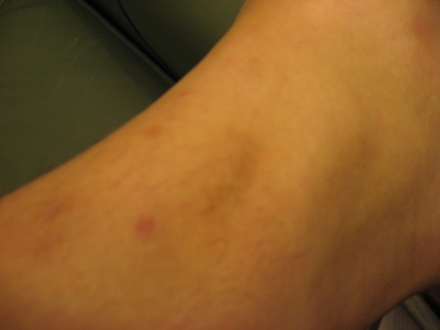 Grappling Hook Accidents 002.jpg Grappling Hook Accidents 002.jpg