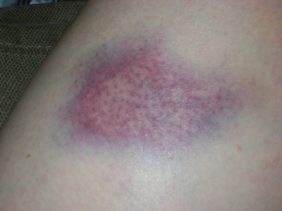 minxy + bike = bruise