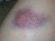 minxy + bike = bruise