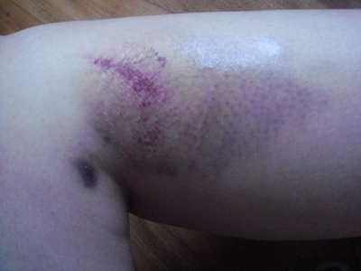 Right side of the knee