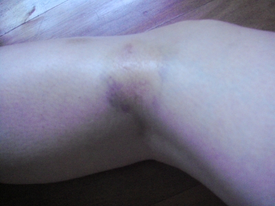 left side of the knee