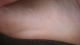 Foot Scar