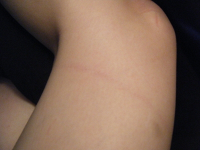 scar