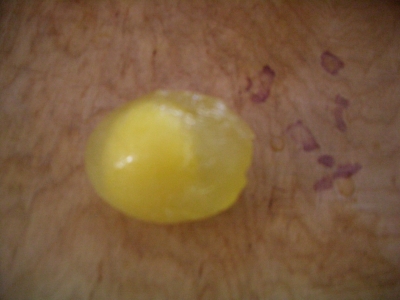 Frozen Egg