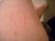 Turf Bite