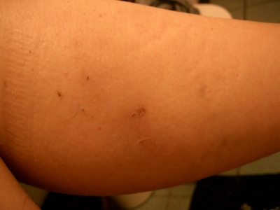 Lasting Wounds