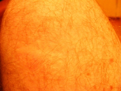 Scar