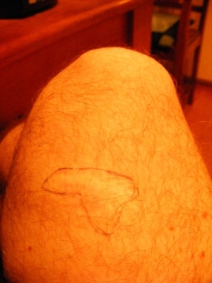Scar