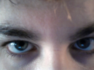Bridge of Nose Scar