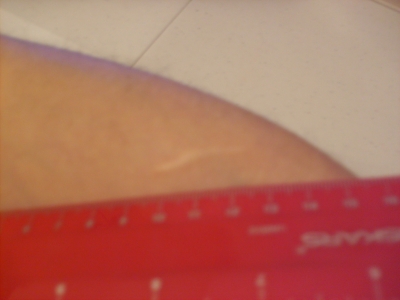 Scar today.