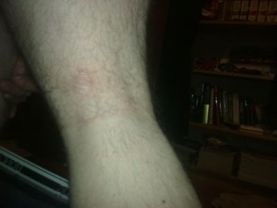 Ouch scars