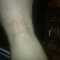 Ouch scars