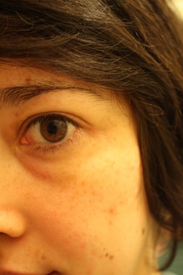 scar photo near the left eye
