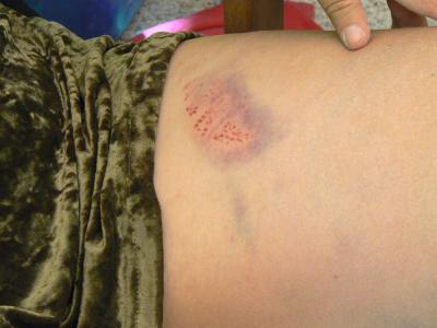 bruise.jpg
