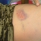 bruise.jpg