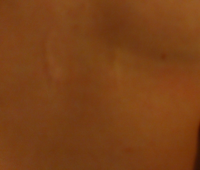 scar