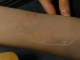 scar outline.JPG