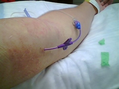 PICC removal 1 PICC removal 1