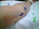 PICC removal 1