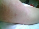 PICC removal 3