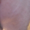 scar.JPG