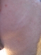 scar.JPG
