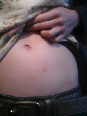 The Scar on my Tummy