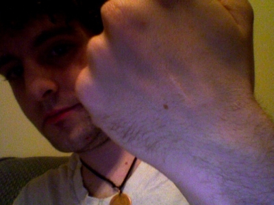Scar on the back of my hand