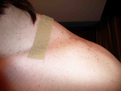 Velcro and skin